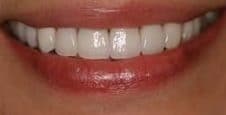 Veneers Dentist near Joliet, Illinois