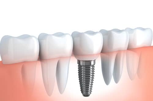 Dental Implants in Joliet IL