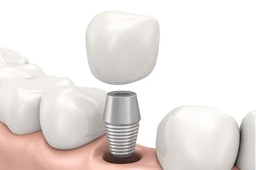 Graphic Visual of a Single Dental Implant