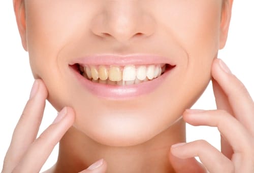 Professional Teeth Whitening in Shorewood Illinois