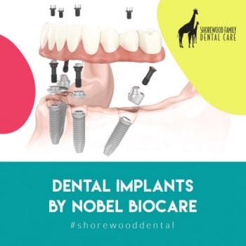 high quality types of dental implants