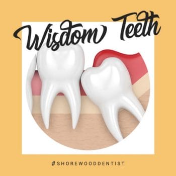 guide to wisdom tooth removal