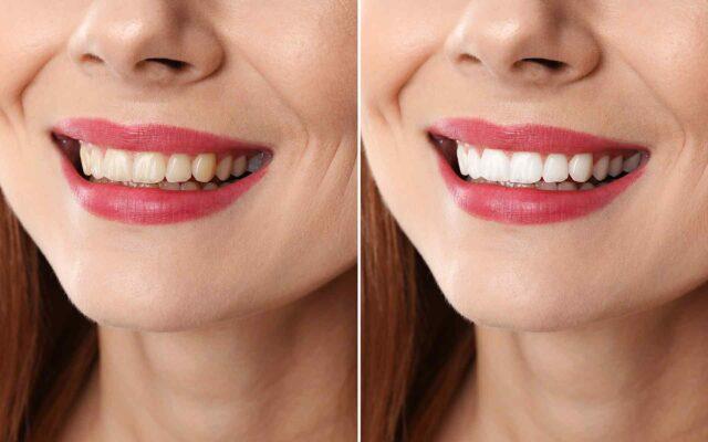 best time to whiten teeth with opalescence teeth whitening