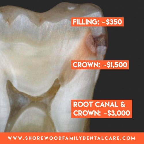 keep up with bi-annual visits to the dentist to avoid root canal therapy