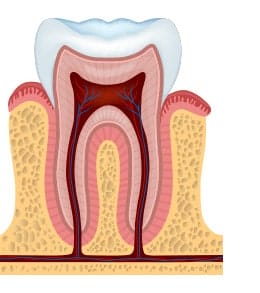 five stages of tooth decay