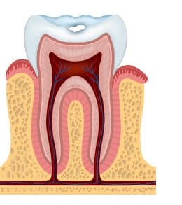 stage 1 of tooth decay with white spots
