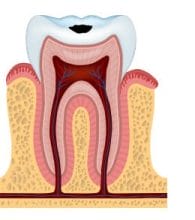 stage 2 of tooth decay with enamel decay
