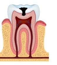 stage 3 of tooth decay with dentin decay