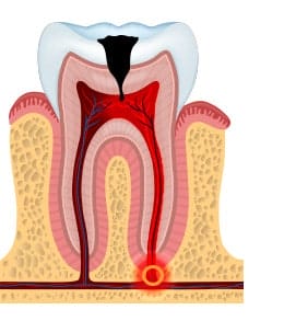 Pulp damage to a tooth
