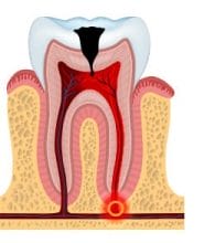Pulp damage to a tooth