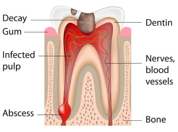 tooth graphic displaying different stages of damage