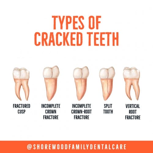 identifying and treating a cracked tooth