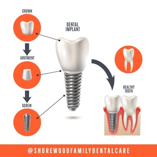 Cheap Dental Implants Cons