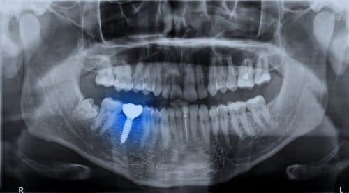 dental implant procedure timeline