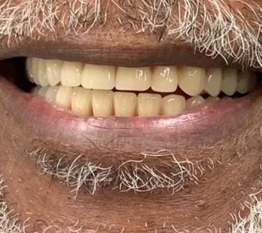 patient after full procedure with his final denture to the implants permanently placed in