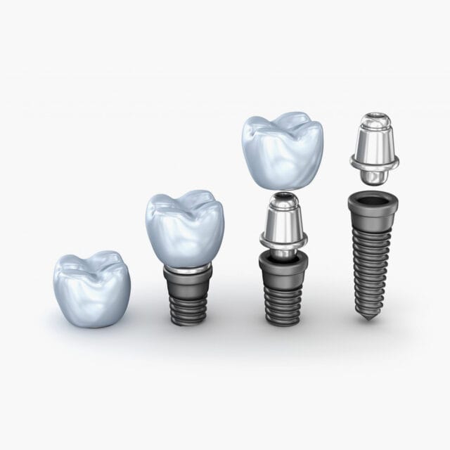 dentist for dental implants in joliet illinois