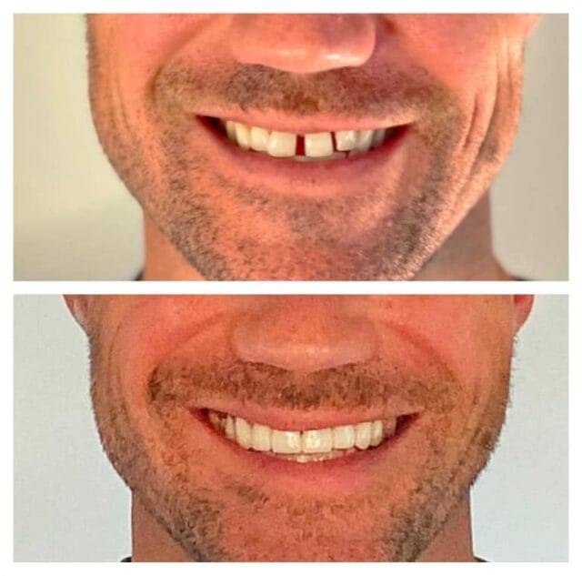 examples of a good porcelain veneers candidate