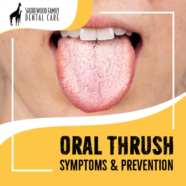 oral thrush symptoms and prevention