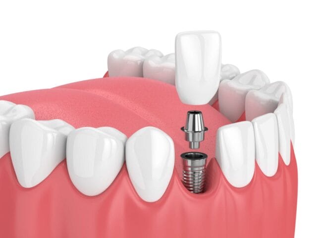 comprehensive guide to taking care of dental implants